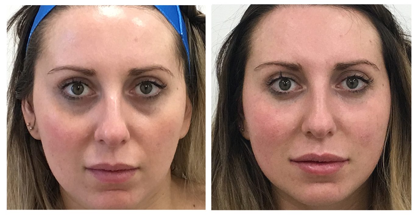 tear trough wrinkles