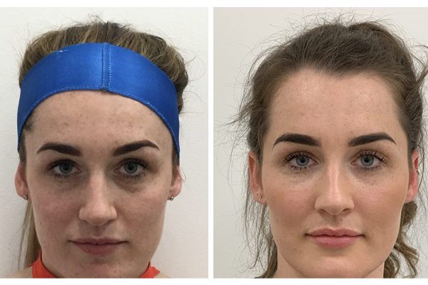 Before & After Cheek Sculpting Before & After Cheek Sculpting