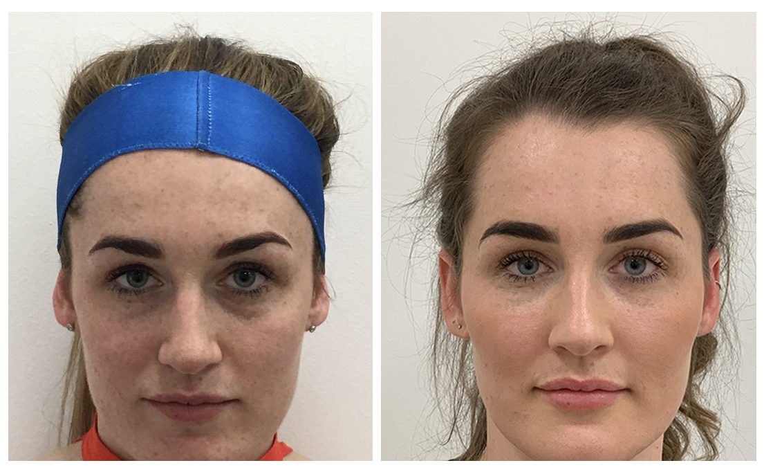 Tear Trough Treatment | DrBK Reading, Award Winning Clinic