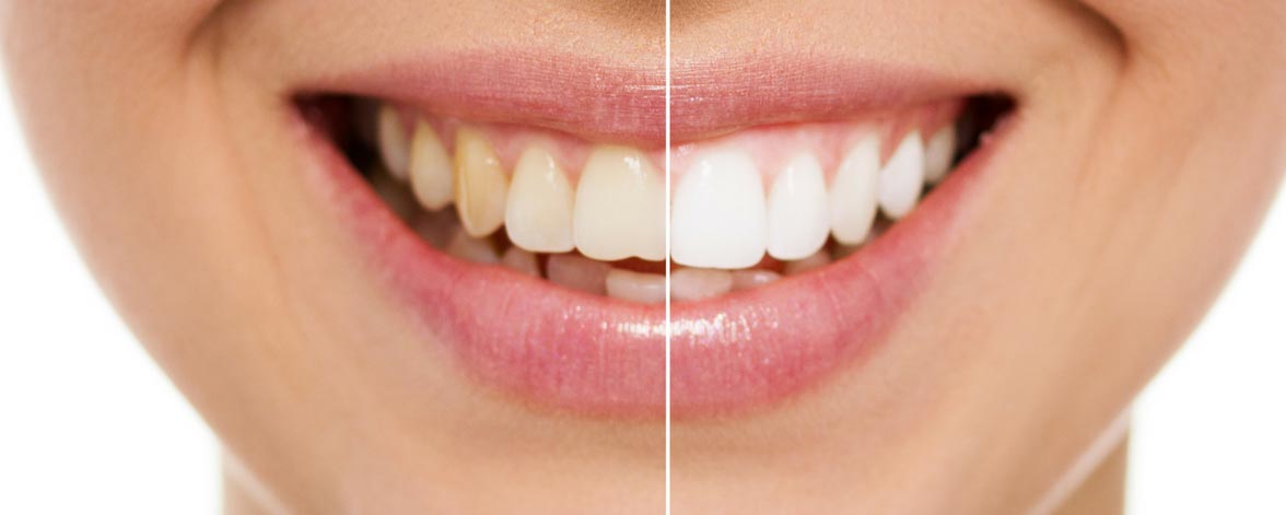 tooth whitening