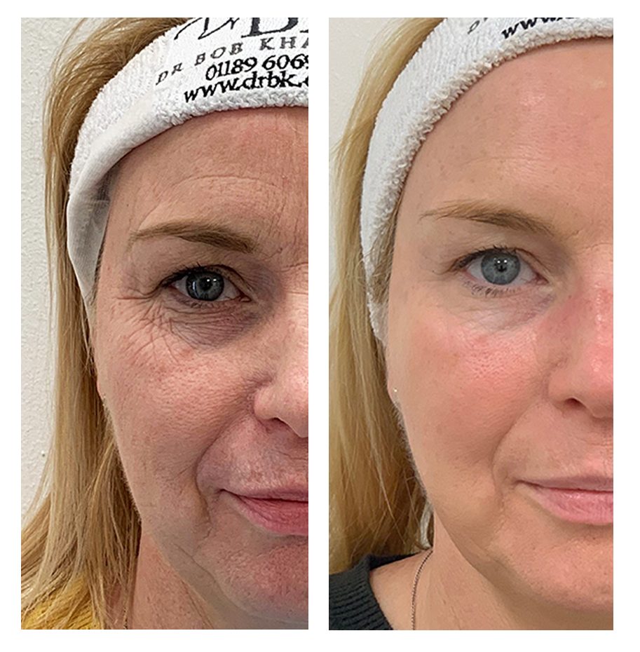 Threading Facelift Before And After
