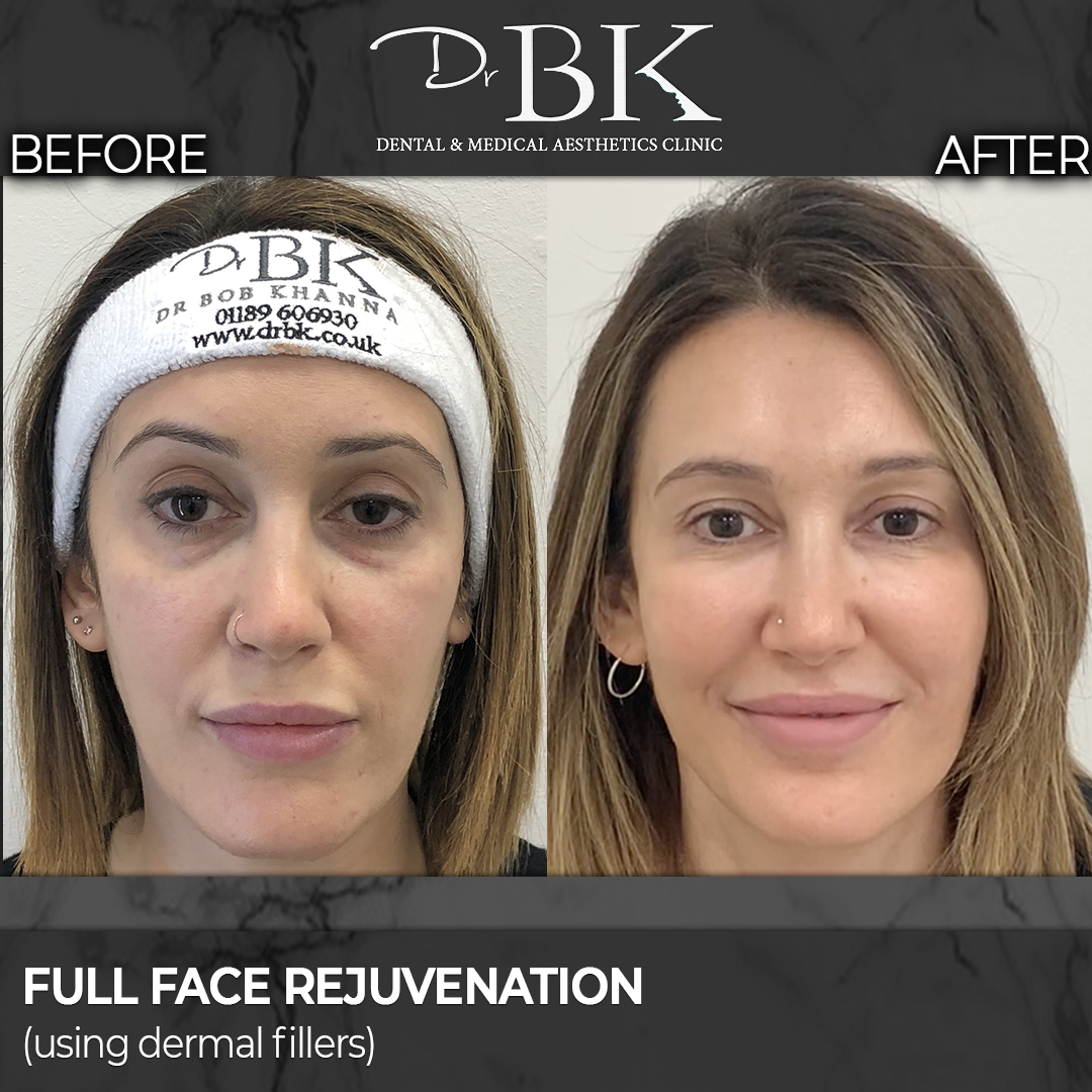 Full Face Rejuvenation: Tear Troughs, Cheeks and Jawline
