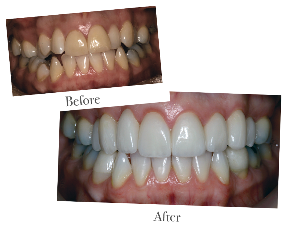 Tooth whitening at DrBK Reading