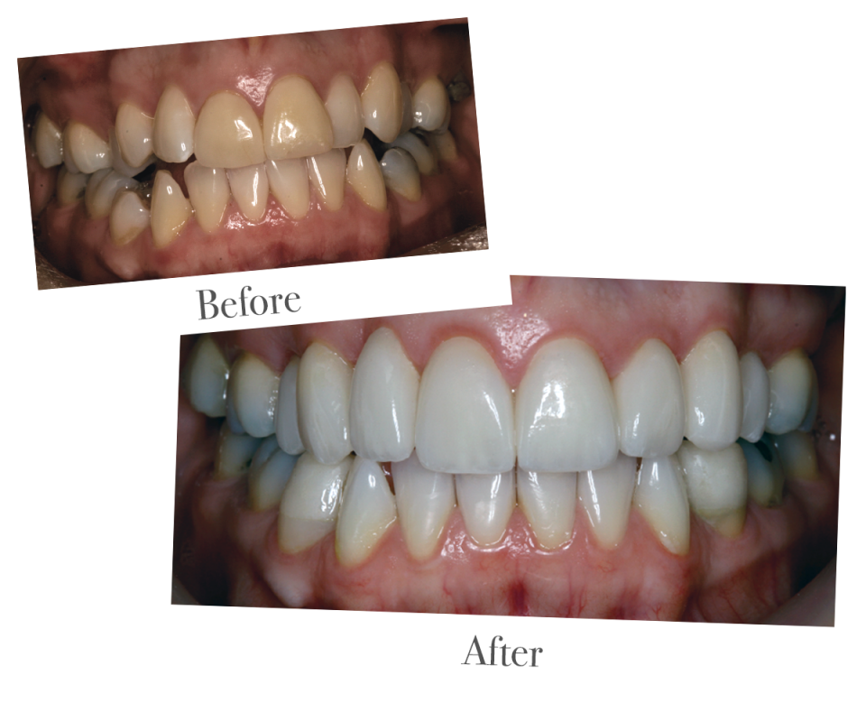 Tooth whitening at DrBK Reading Tooth whitening at DrBK Reading