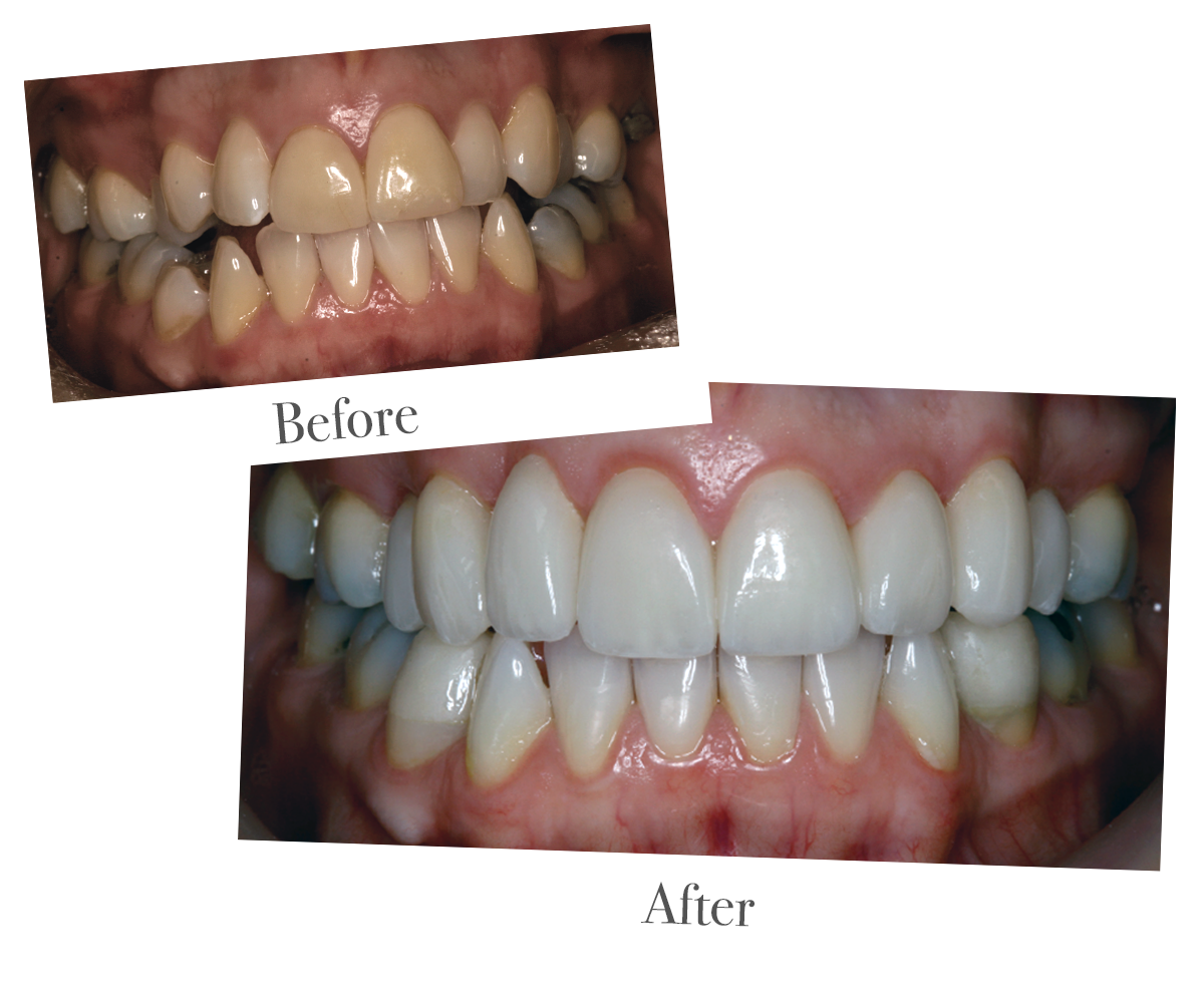 Tooth whitening at DrBK Reading