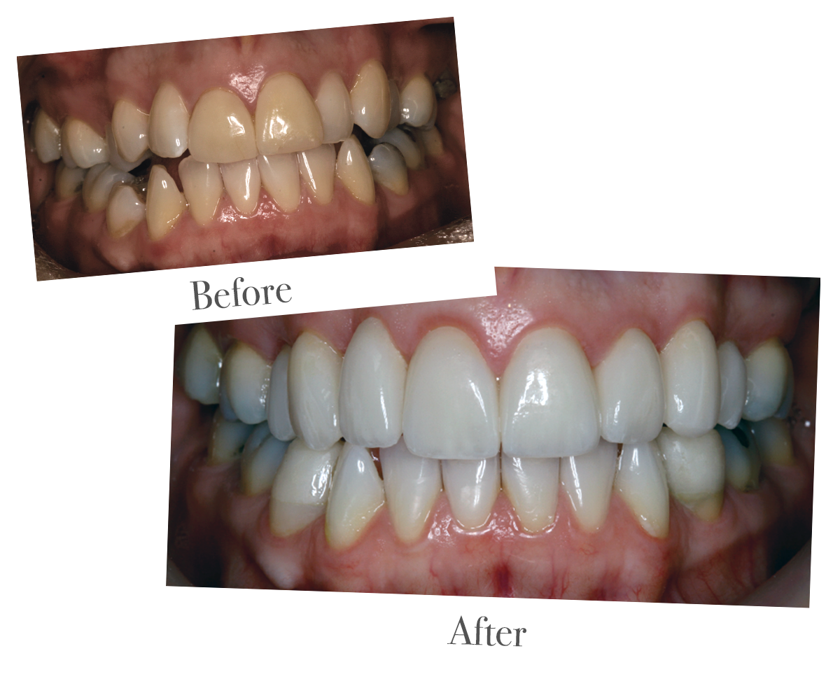 Tooth whitening at DrBK Reading Tooth whitening at DrBK Reading