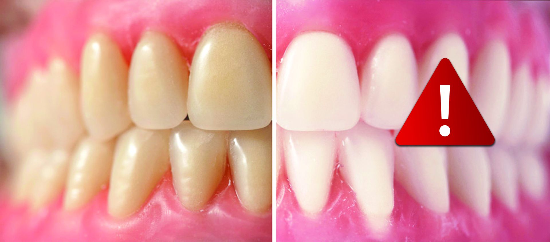 teeth-whitening-dangers