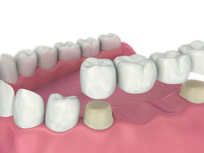 dental bridge treatment cosmetic dentist
