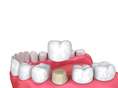 dental crowns drbk clinic reading
