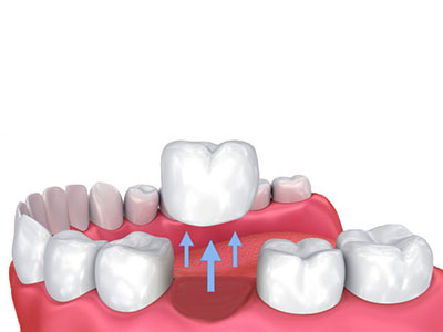 dental extraction treatment drbk clinic