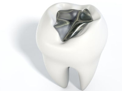 tooth coloured restorations fillings