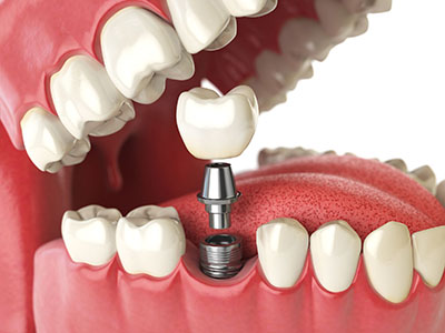 dental implants drbk clinic reading