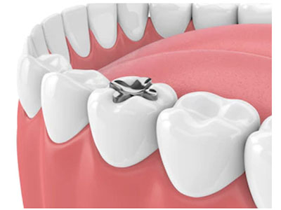 dental inlays drbk clinic