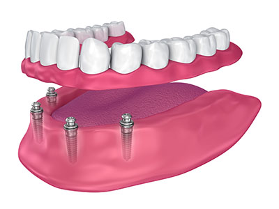 dentures drbk cosmetic dentist