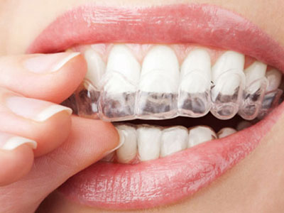 clear aligners with smilelign