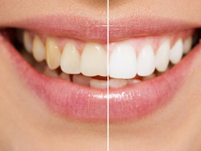 teeth whitening drbk dentist