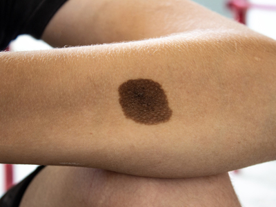 laser birthmark removal treatment